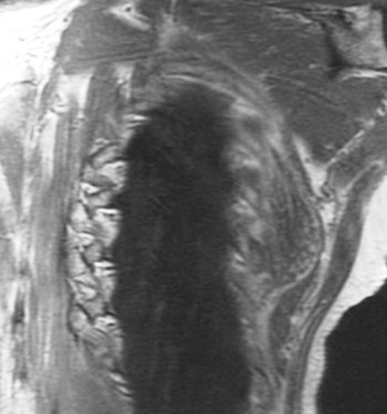 Figure 3 for case Elastofibroma dorsi